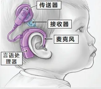 江西人工耳蜗纳入医保后如何报名申请？