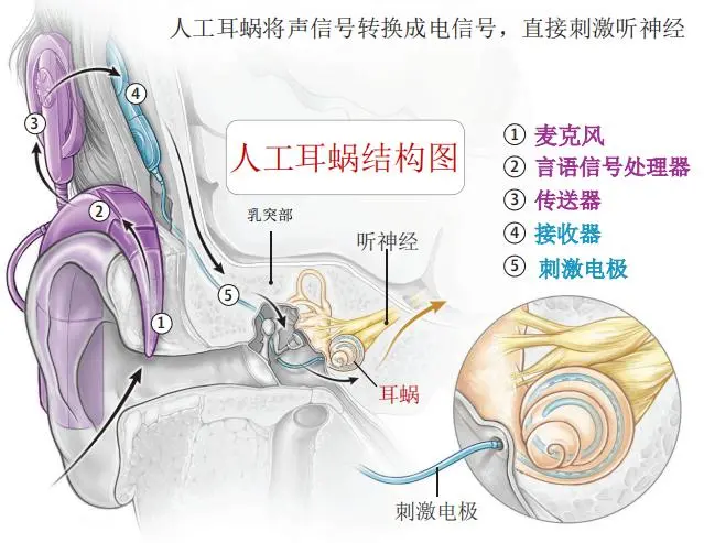 江西人工耳蜗纳入医保后如何报名申请？